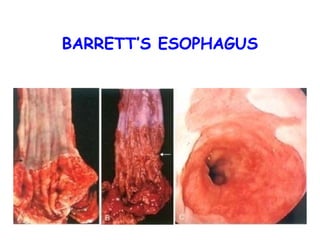 BARRETT’S ESOPHAGUS

 
