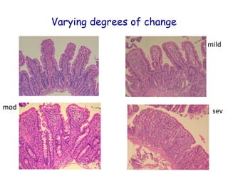 Varying degrees of change
mild

mod

sev

 