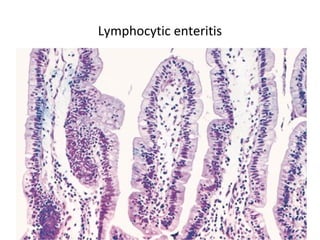 Lymphocytic enteritis

 