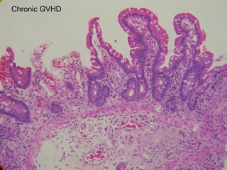 Chronic GVHD

 