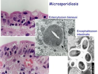 Microsporidiosis
Entercytozoon bieneusi

Encephalitozoon
intestinalis

 