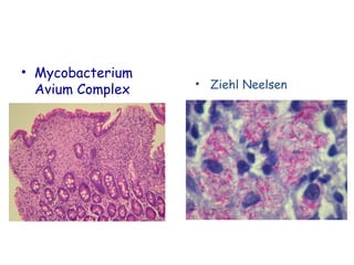 • Mycobacterium
Avium Complex

• Ziehl Neelsen

 