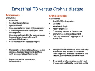 Intestinal TB versus Crohn’s disease
Tuberculosis:

Granulomas
• Caseation
• Confluent granulomas
• Lymphoid cuff
• Granulomas larger than 400 micrometer
• 5 or more granulomas in biopsies from
one segment
• Granulomas located in the submucosa or
in granulation tissue: often with
palisaded histiocytes
• Granulomas in the ileocecal region

•

Nonspecific inflammatory changes in the
same and adjacent segments to those
with granulomatous iflammation

•

Disproportionate submucosal
inflammation

Crohn’s disease:

Granulomas
• Small (<200 micrometer)
• Discrete
• Very few / single
• Poorly organised
• Commonly located in the mucosa
• Granulomas in the rectosigmoid
• “microgranulomas”: aggregates of
histiocytes

•

Nonspecific inflammation more diffusely
distributed and not restricted to the
same segments or those adjacent to the
sites of granulomatous iflammation

•

Crypt-centric inflammation: pericryptal
granulomas and focally enhanced colitis

 