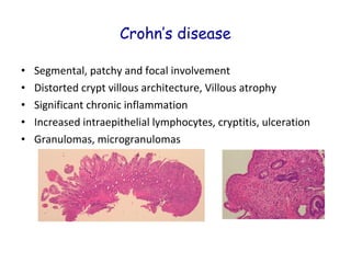 Crohn’s disease
•
•
•
•
•

Segmental, patchy and focal involvement
Distorted crypt villous architecture, Villous atrophy
Significant chronic inflammation
Increased intraepithelial lymphocytes, cryptitis, ulceration
Granulomas, microgranulomas

 