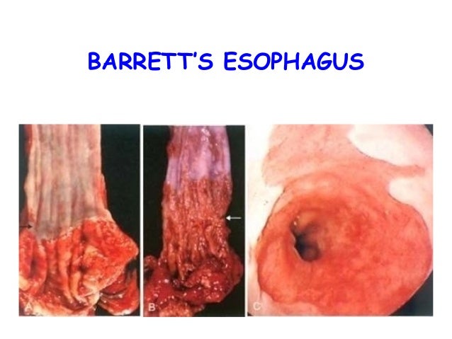 An interpretation of Endoscopic biopsy An interpretation of Endoscopic biopsy