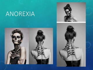 ANOREXIA
 