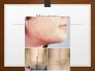 Hirsutismo 
 