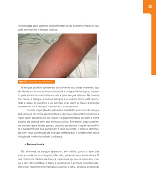 35
mencionadas pelo paciente pareciam tratar-se do exantema (figura 5) que
pode acompanhar a dengue clássica.
Figura 5 - paciente com exantema.
Foto:LeonardoZenha/portal.saude.gov.br
A dengue pode se apresentar clinicamente sob várias maneiras, que
vão desde as formas assintomáticas até a dengue hemorrágica, passan-
do pela síndrome viral indiferenciada e pela dengue clássica. Na maioria
dos casos, a dengue é doença benigna e o quadro clínico está relacio-
nado à idade do paciente e ao sorotipo viral, além de haver diferenças
importantes se a infecção é primária ou subsequente.
	 Grande proporção dos pacientes infectados pelo vírus da dengue
apresenta-se de forma assintomática e, dos que apresentam sintomas, a
maior parte apresenta-se de maneira oligossintomática ou com a forma
clássica da doença, com boa evolução clínica. Entretanto, alguns pacien-
tes evoluem para formas graves, podendo apresentar choque hipovolêmi-
co e sangramentos que aumentam o risco de morte. A correta identifica-
ção com risco aumentado de evolução desfavorável é fundamental para a
redução da morbimortalidade da doença.
•	 Forma clássica
Os sintomas da dengue aparecem, em média, quatro a sete dias
após a picada de um mosquito infectado, podendo variar entre dois e 15
dias. Na forma clássica da doença, o paciente apresenta febre alta, mial-
gia e dor retro-orbitária. A febre é geralmente a primeira manifestação,
com início repentino e temperatura superior a 38ºC. Cefaleia, prostração
 