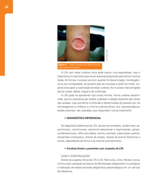 48
A LTA com lesão cutânea única pode evoluir cura espontânea, mas o
tratamento é importante para evitar eventual progressão para forma mucosa
tardia. As formas mucosas ocorrem quando há disseminação, hematogêni-
ca ou por contiguidade, do parasito para as mucosas e pode ser tardia, sur-
gindo anos após a cicatrização da lesão cutânea. As mucosas mais atingidas
são as nasais, labiais, lingual e de orofaringe.
A LTA pode se apresentar sob outras formas: forma cutânea dissemi-
nada, que se caracteriza por lesões cutâneas múltiplas distantes dos locais
das picadas, cuja ocorrência é atribuída à disseminação do parasito por via
hematogênica ou linfática; e a forma cutânea difusa, rara, caracterizada por
lesões extensas, não ulceradas, que respondem mal ao tratamento.
•	 DIAGNÓSTICO DIFERENCIAL
No diagnóstico diferencial da LTA, devem-se considerar: piodermites, es-
porotricose, cromomicose, carcinoma basocelular e espinocelular, paraco-
cocidioidomicose, sífilis secundária, ectima, psoríase, tuberculose cutânea,
hanseníase virchowiana, úlceras de estase, úlceras da anemia falciforme e
outras, dependendo da forma e do local do acometimento.
•	 Conduta frente a pacientes com suspeita de LTA
CASO 2 (CONTINUAÇÃO)
Diante da suspeita clínica de LTA no Sr. Raimundo, a Dra. Renata o enca-
minhou para realização do exame de Montenegro (diagnóstico imunológico)
e realização de biópsia da lesão (diagnóstico parasitológico) em um serviço
de referência.
Figura 6 - Lesão sugestiva de leishmaniose
tegumentar americana
Fonte:BRASIL(2007).
 