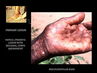 Treponema Rash Endemic treponematoses | PPTX