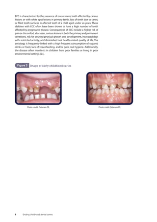 Ending early childhood caries | PDF
