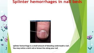 Splinter Hemo endocarditis pericarditis myocarditis | PDF