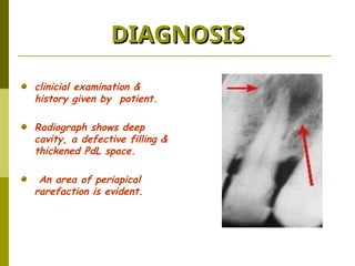 Rarefaction Radiograph Endodontic Emergencies and their management | PPT