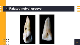 4. Palatogingival groove
24
 