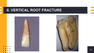 6. VERTICAL ROOT FRACTURE
28
 