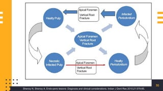 30
Shenoy N, Shenoy A. Endo-perio lesions: Diagnosis and clinical considerations. Indian J Dent Res 2010;21:579-85.
 