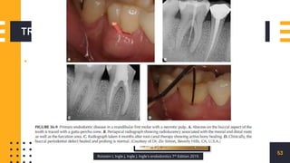TREATMENT
▪ ENDODONTIC
TREATMENT
53
Rotstein I, Ingle J, Ingle J. Ingle's endodontics 7th Edition 2019.
 