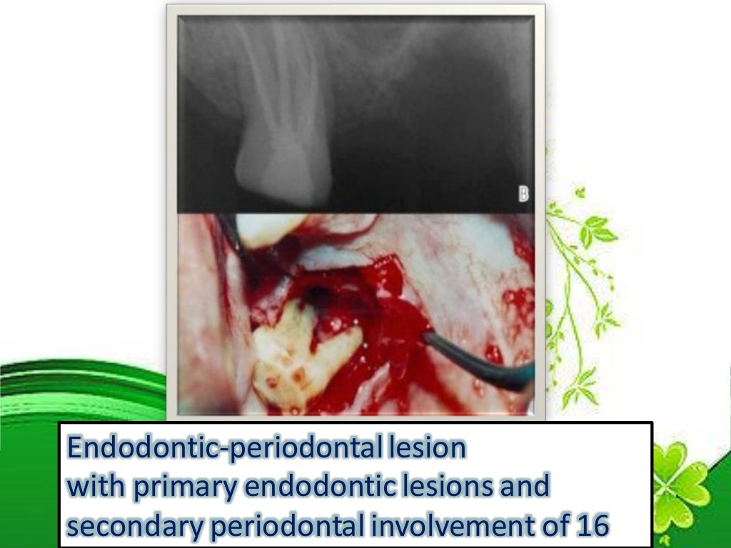 Endo perio lesions