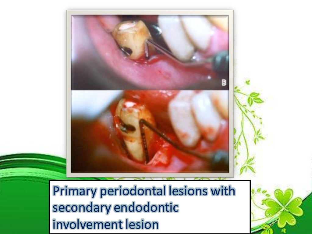 Endo perio lesions