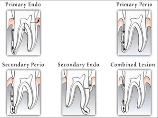 Endo-Perio relationship | PPTX