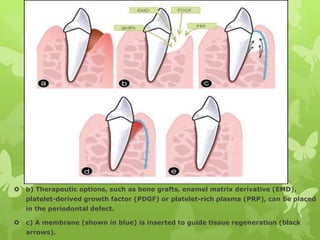 

b) Therapeutic options, such as bone grafts, enamel matrix derivative (EMD),
platelet-derived growth factor (PDGF) or platelet-rich plasma (PRP), can be placed
in the periodontal defect.



c) A membrane (shown in blue) is inserted to guide tissue regeneration (black
arrows).

 