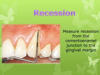 Measure recession
from the
cementoenamel
junction to the
gingival margin

 