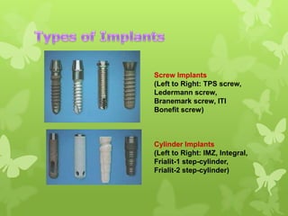 Screw Implants
(Left to Right: TPS screw,
Ledermann screw,
Branemark screw, ITI
Bonefit screw)

Cylinder Implants
(Left to Right: IMZ, Integral,
Frialit-1 step-cylinder,
Frialit-2 step-cylinder)

 