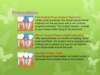 First Surgical Phase (Implant Placement)
Under Local anesthetic the dentist places dental
implants into the jaw bone with a very precise
surgical procedure. The implant remains covered
by gum tissue while fusing to the jaw bone.
Second Surgical Phase (Implant Uncovery)
After approximately six months of healing. Under
local anesthetic, the implant root is exposed and a
healing post is placed over top of it so that the
gum tissue heals around the post.
Prosthetic Phase (Teeth)
Once the gums have healed, an implant crown is
fabricated and screwed down to the implant.

 