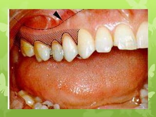 surgical procedure for periodontal diseases