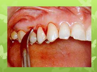 surgical procedure for periodontal diseases