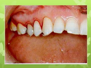 surgical procedure for periodontal diseases