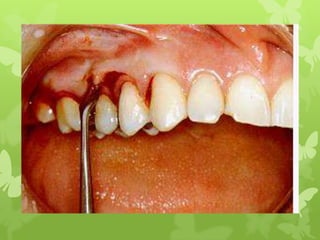 surgical procedure for periodontal diseases
