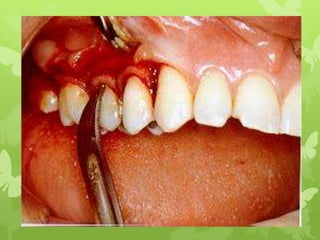 surgical procedure for periodontal diseases