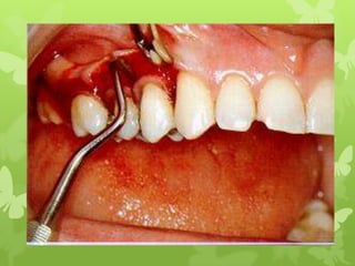 surgical procedure for periodontal diseases