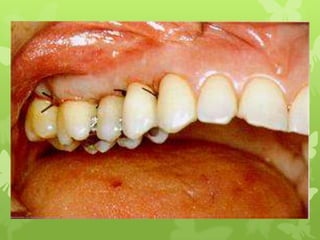 surgical procedure for periodontal diseases