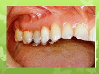 surgical procedure for periodontal diseases
