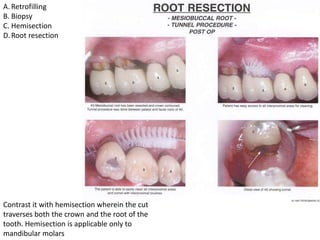 Tooth Hemisection Endo-QA.pptx