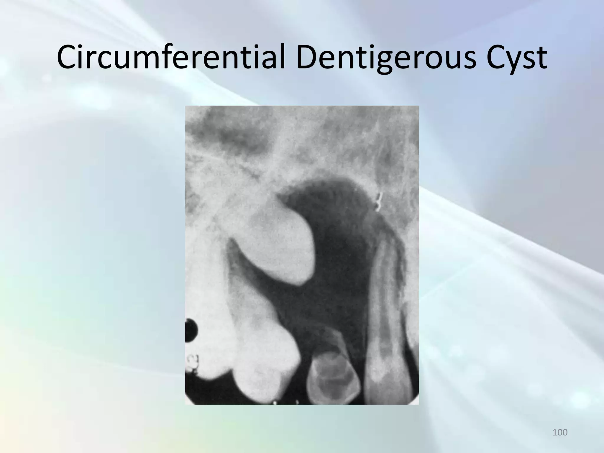 Circumferential Dentigerous Cyst




                                   100
 