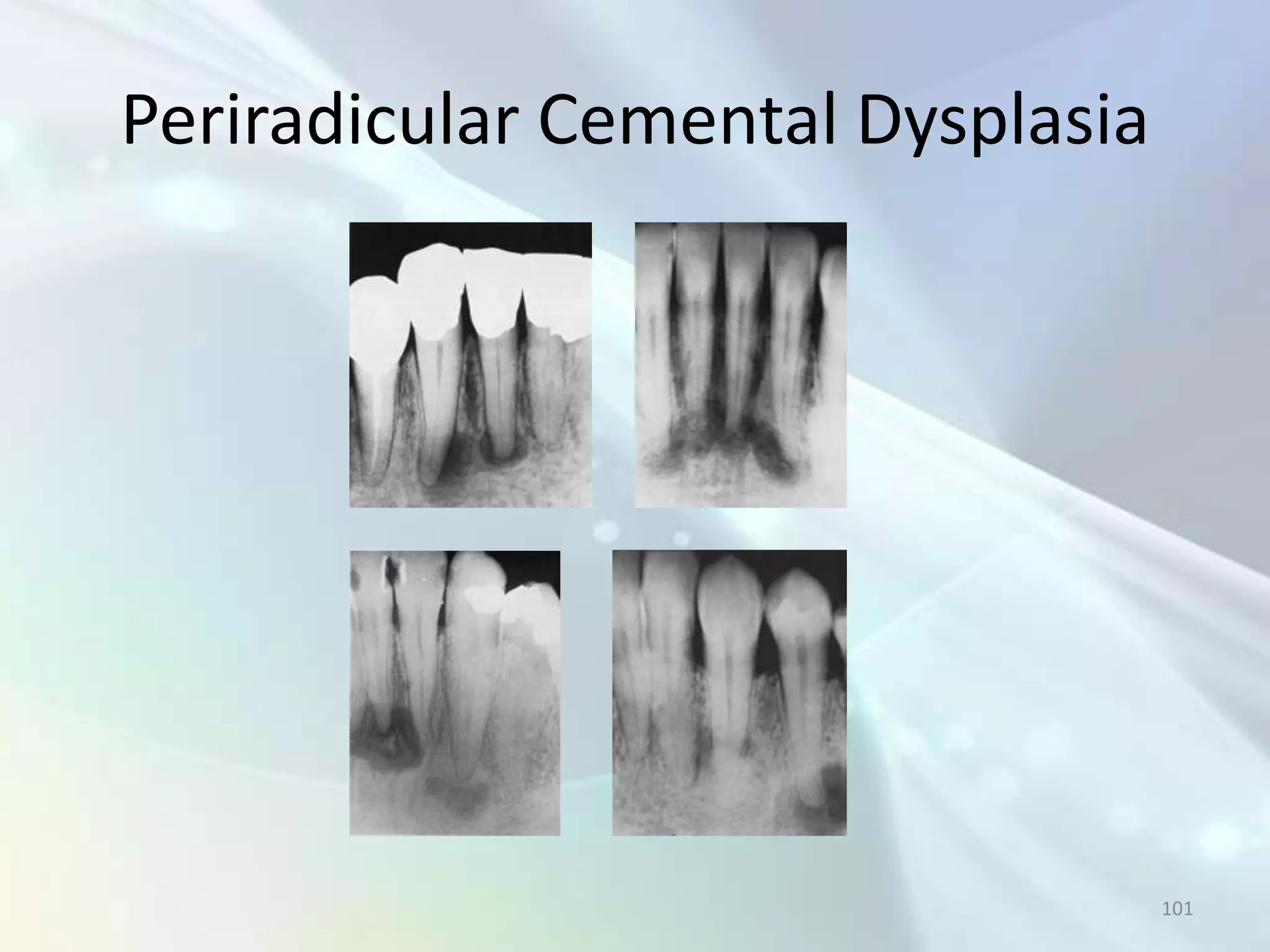 Periradicular Cemental Dysplasia




                                   101
 