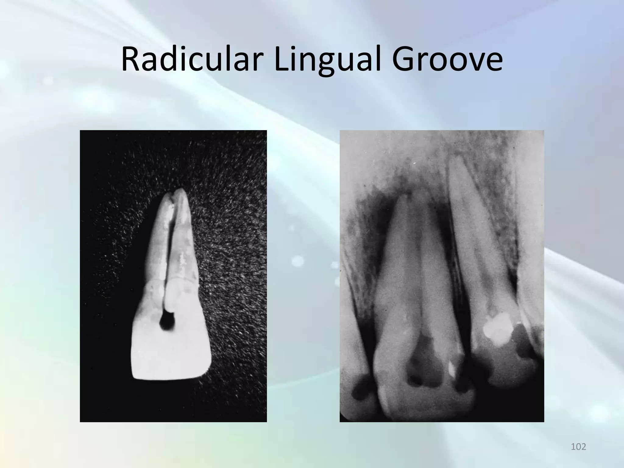 Radicular Lingual Groove




                           102
 