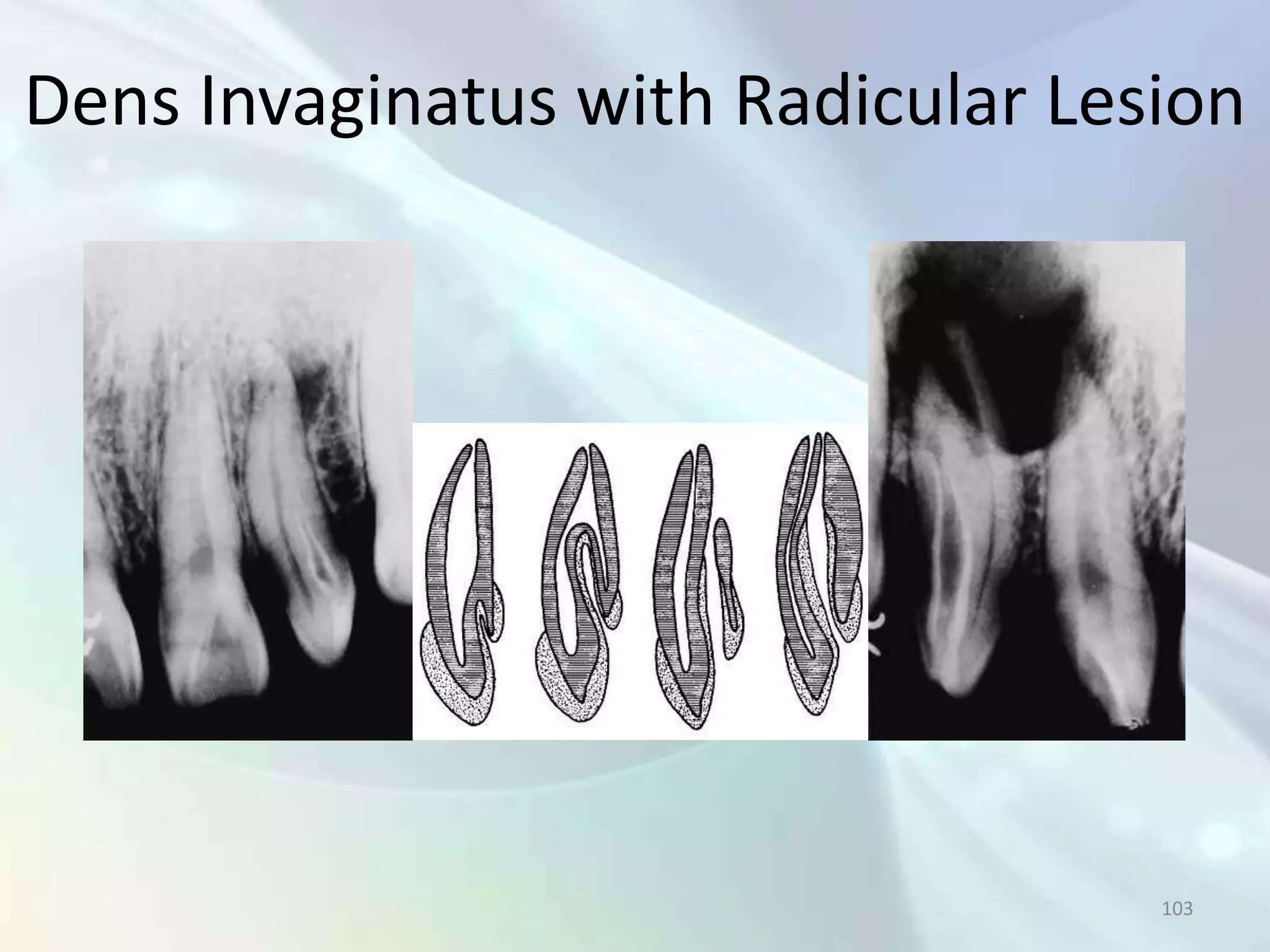 Dens Invaginatus with Radicular Lesion




                                   103
 