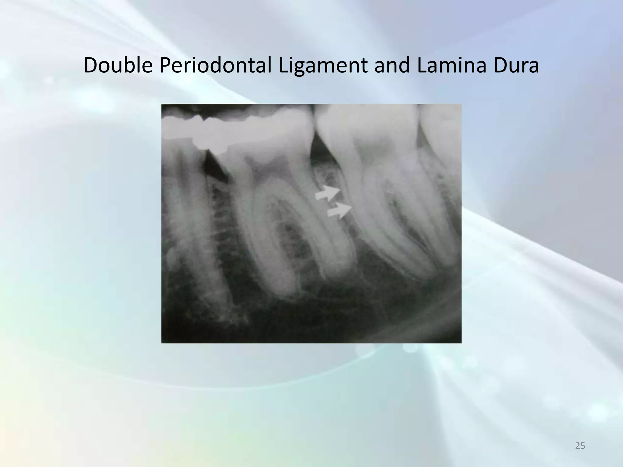 Double Periodontal Ligament and Lamina Dura




                                              25
 