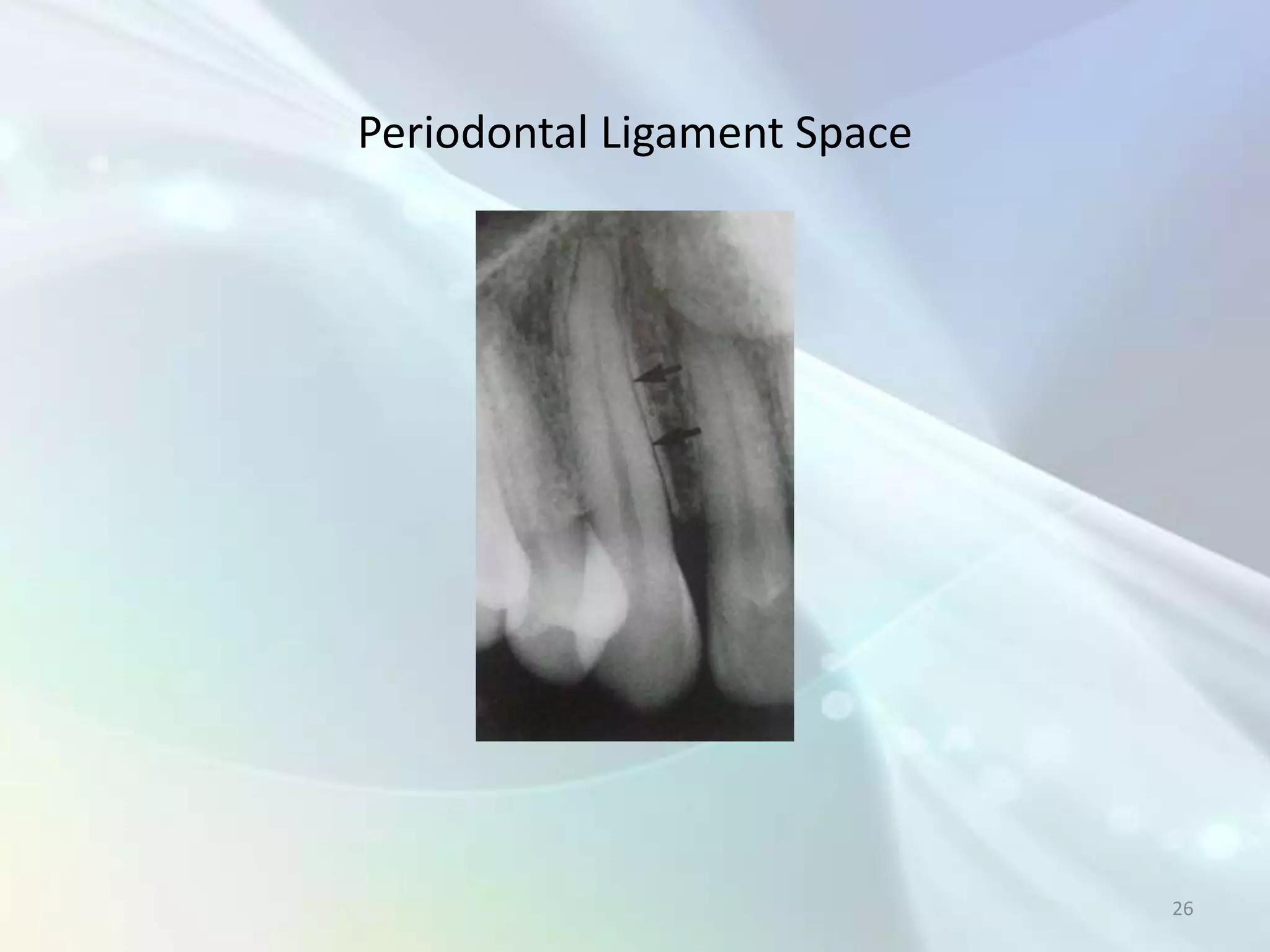 Periodontal Ligament Space




                             26
 