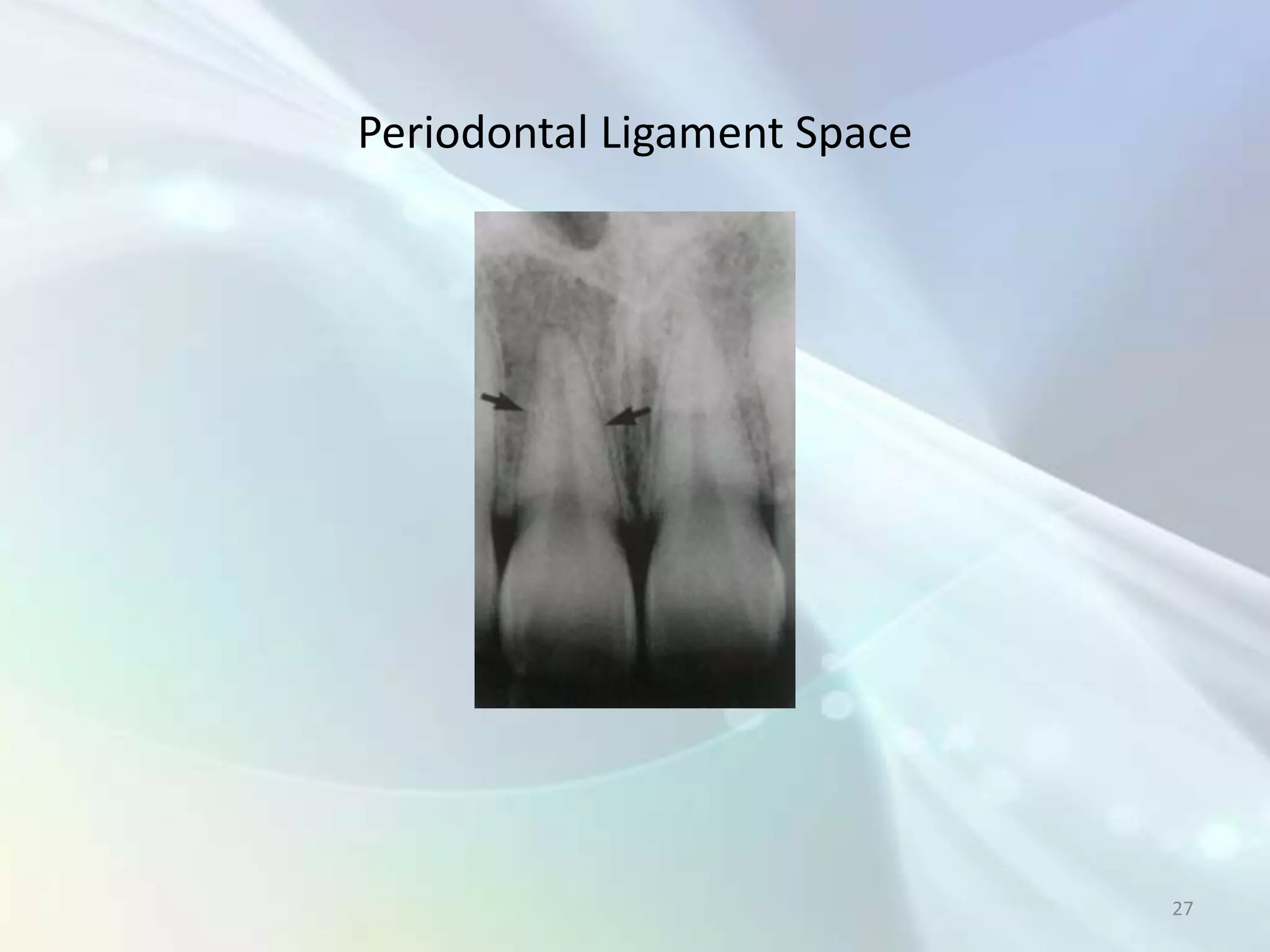 Periodontal Ligament Space




                             27
 