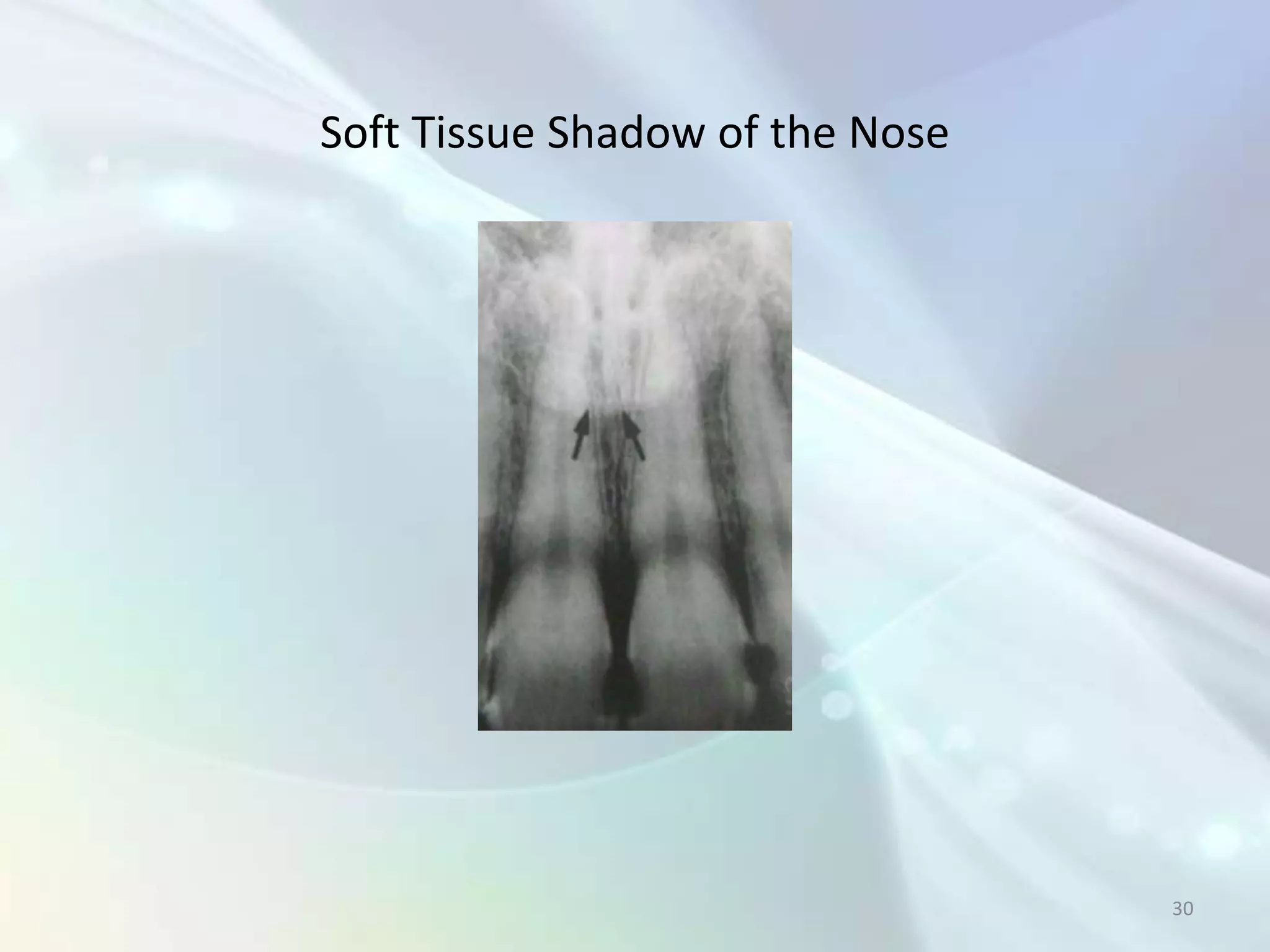 Soft Tissue Shadow of the Nose




                                 30
 
