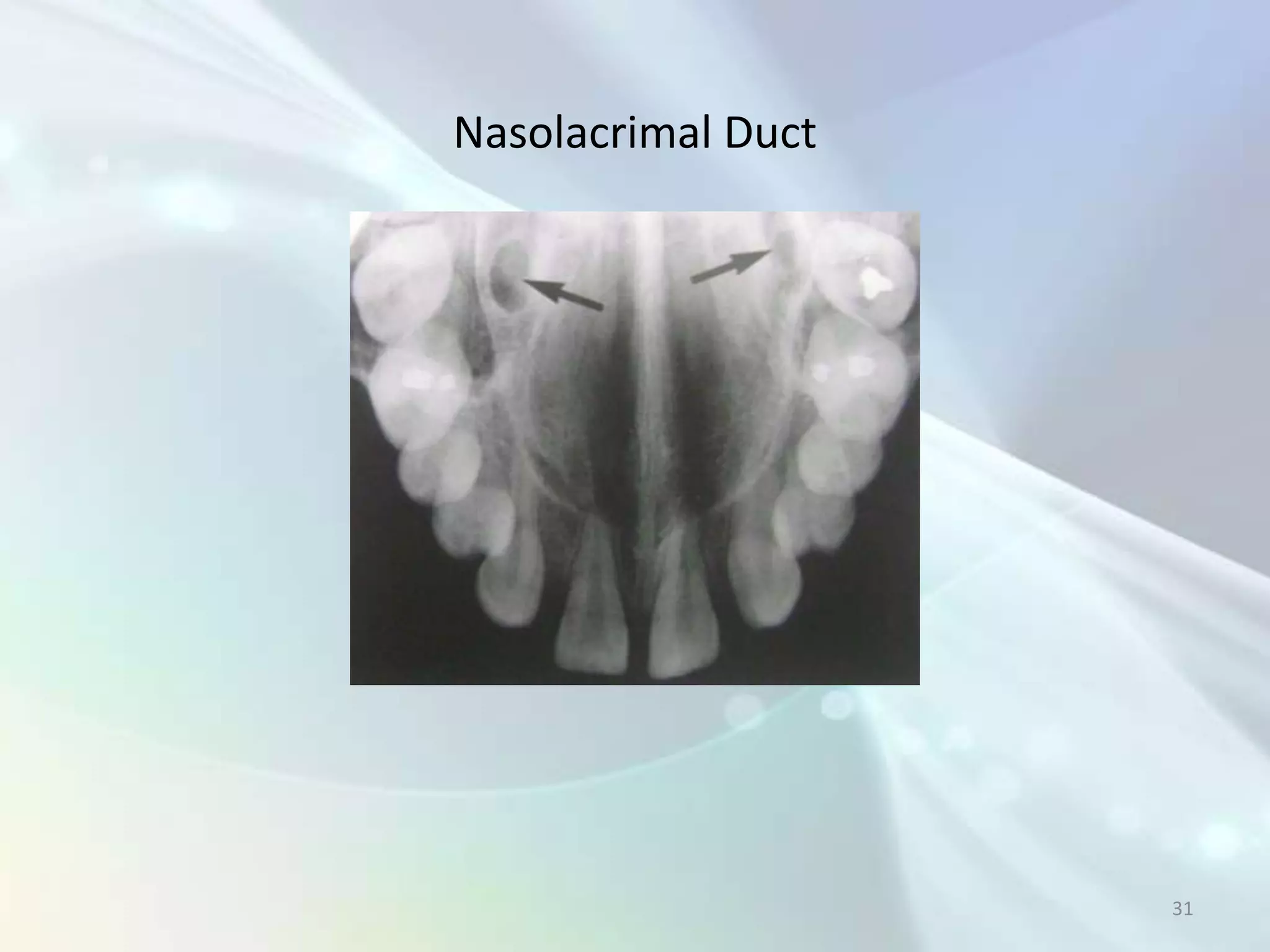 Nasolacrimal Duct




                    31
 
