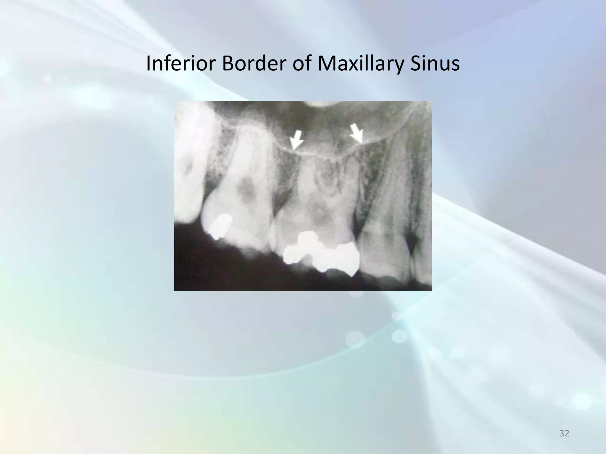 Inferior Border of Maxillary Sinus




                                     32
 