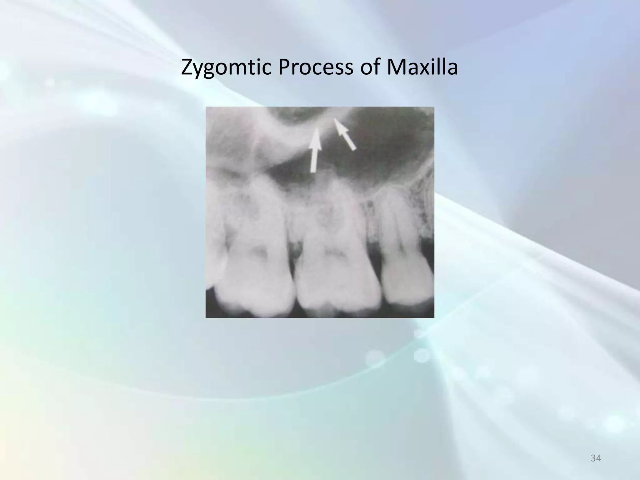 Zygomtic Process of Maxilla




                              34
 