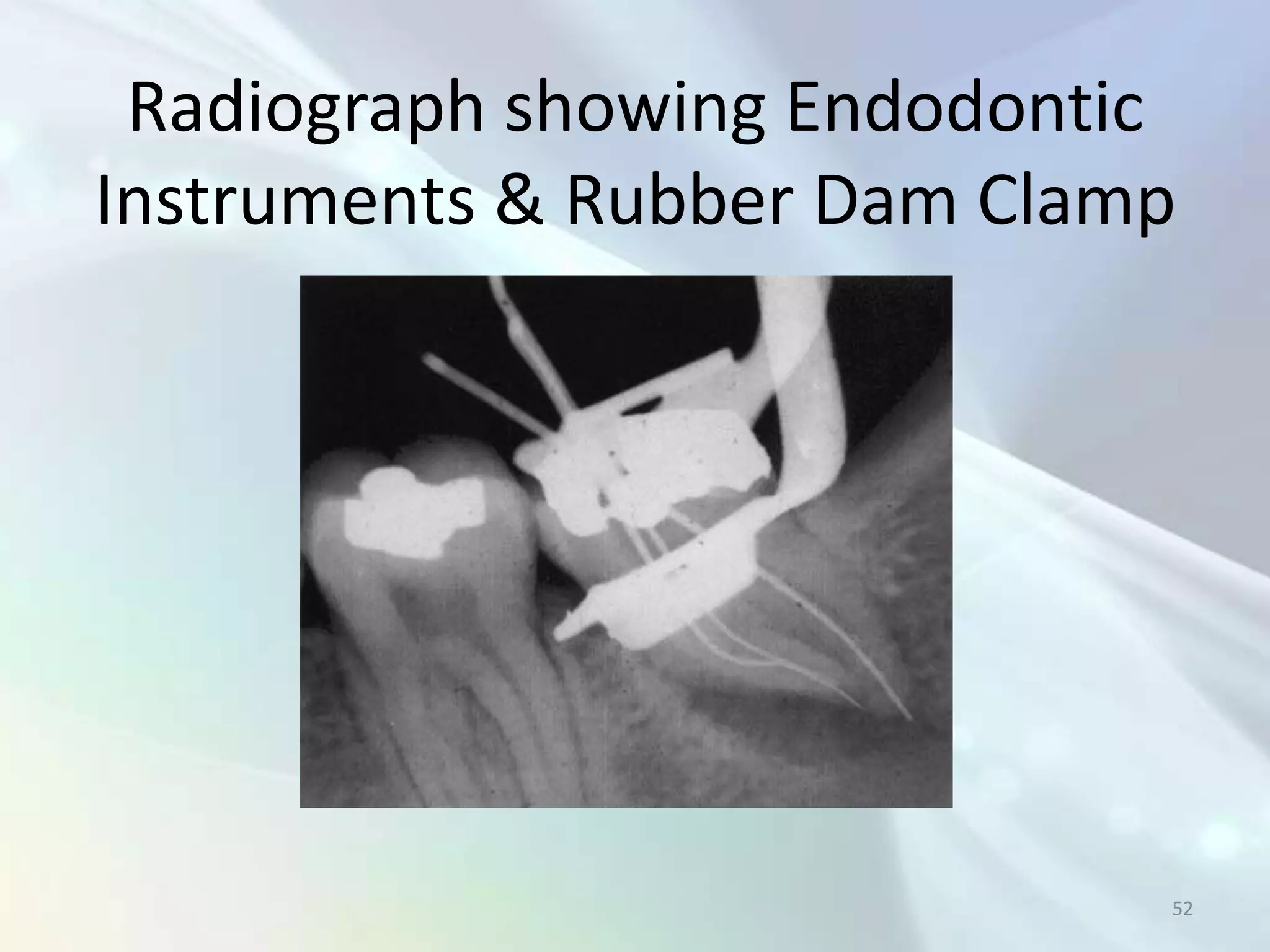 Radiograph showing Endodontic
Instruments & Rubber Dam Clamp




                             52
 