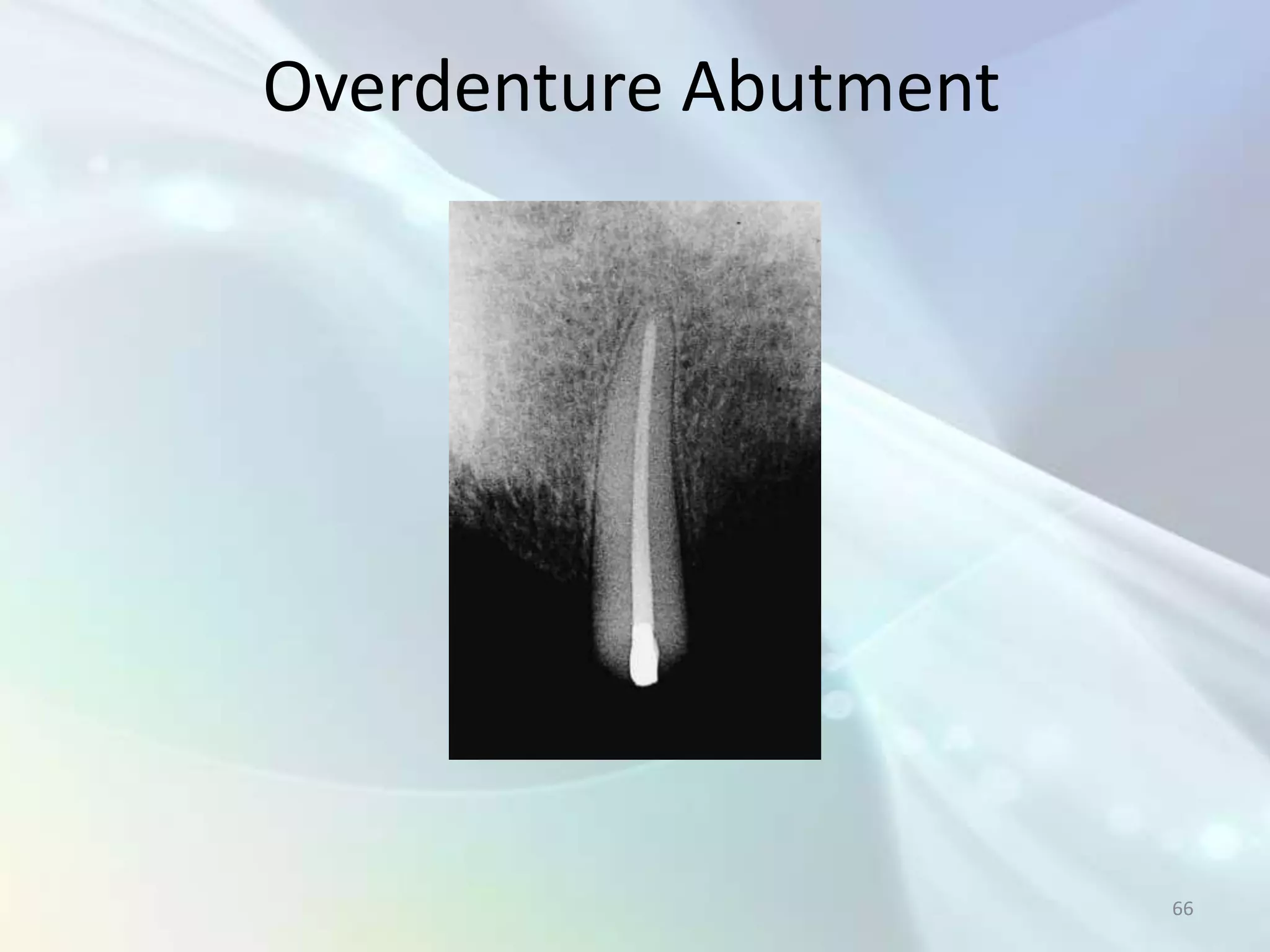 Overdenture Abutment




                       66
 